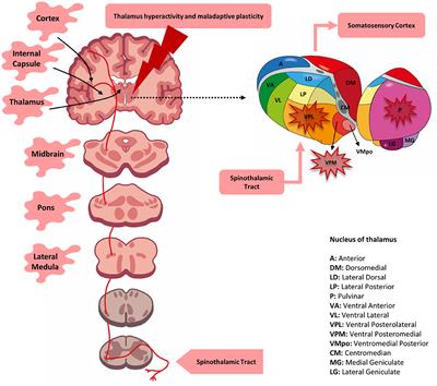 Central Post-Stroke Pain: An Integrative Review of Somatotopic Damage, Clinical Symptoms, and Neurophysiological Measures